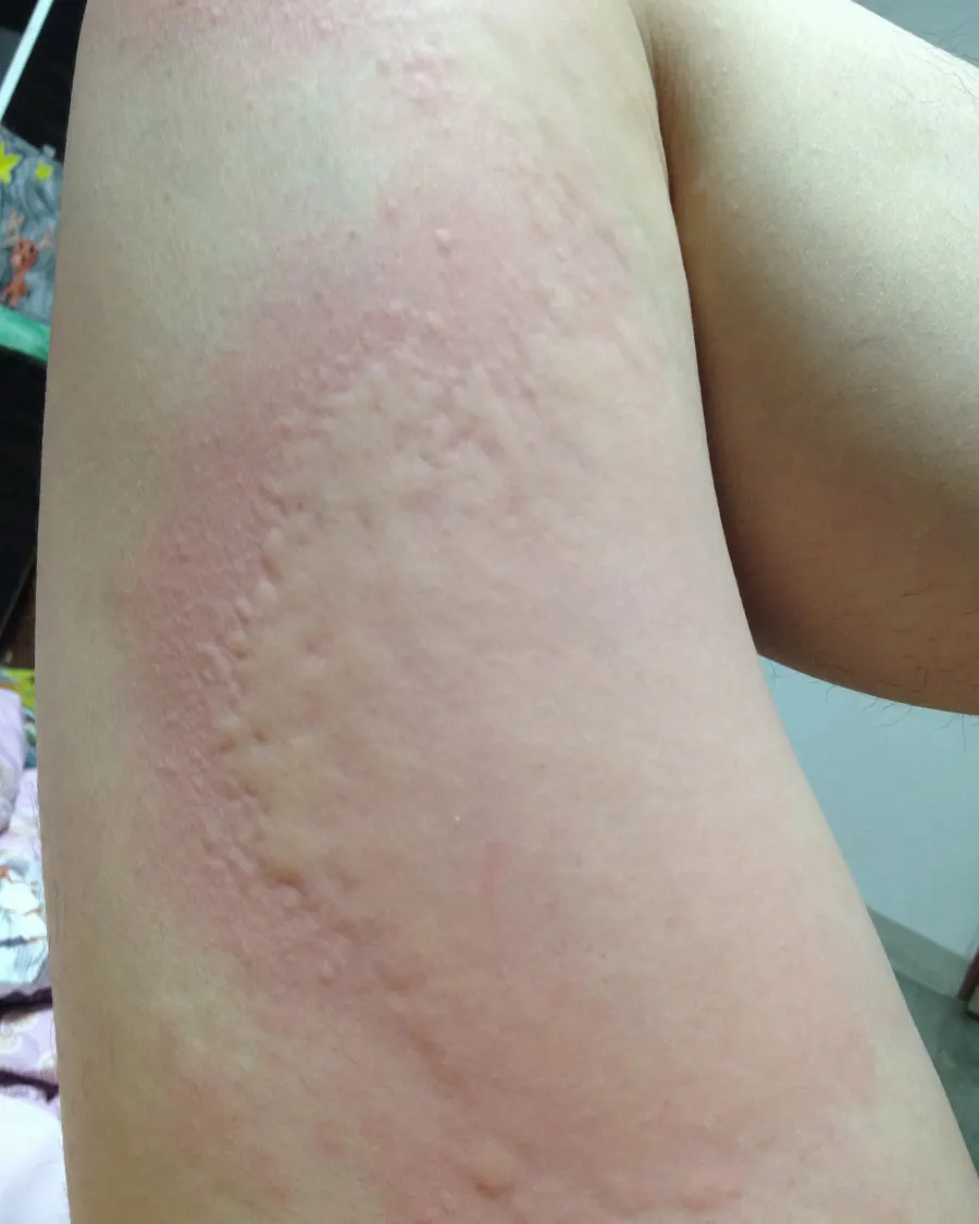 Hives & Urticaria at Cinch Clinics